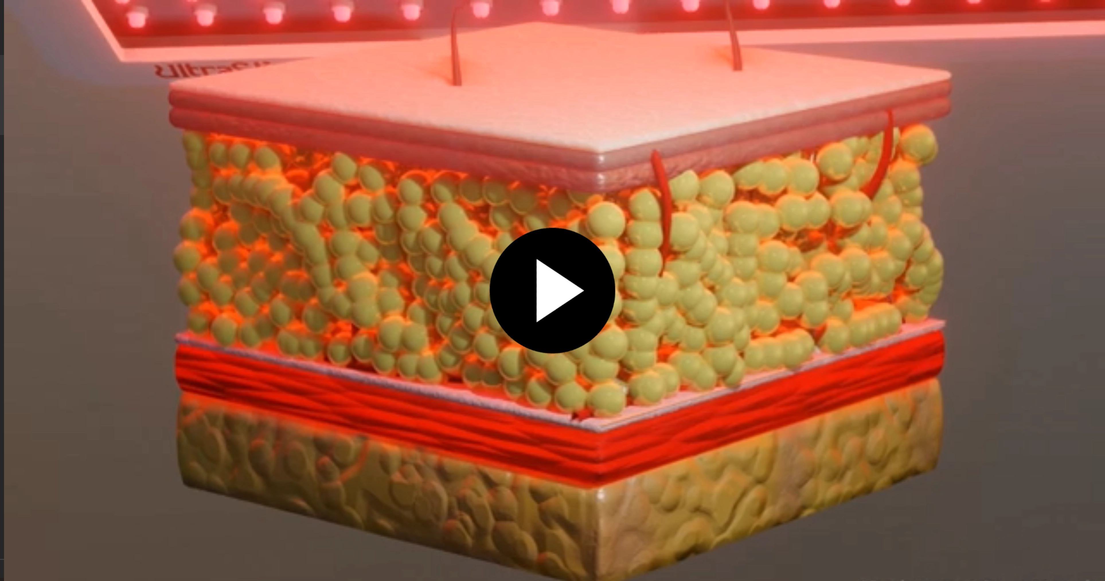 How UltraSlim Works