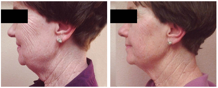 75-Year-Old Patient